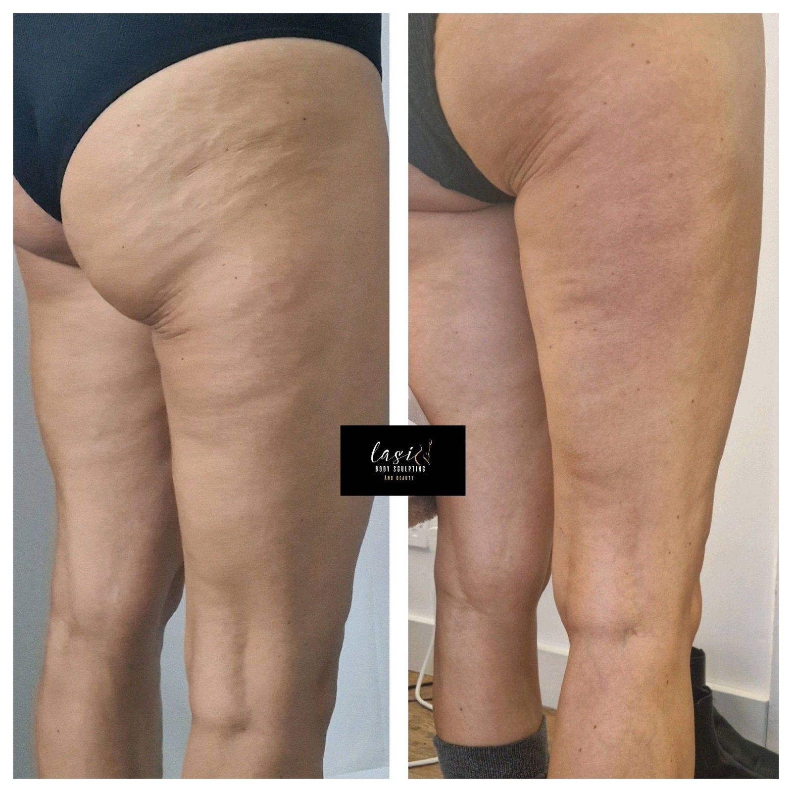 pre cellulite reduction treatment and post cellulite reduction treatment image